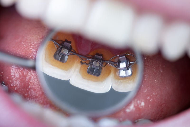 What Advantages Do Lingual Braces Have Over Traditional? - Hardy Pediatric  Dentistry & Orthodontics