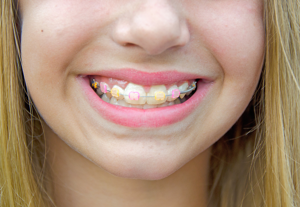 clear braces with colored bands