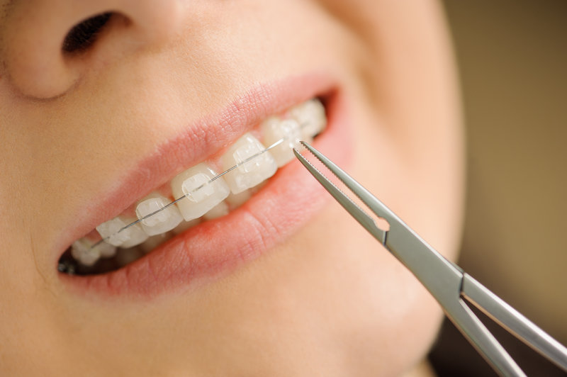 Dental Metal Ceramic Lingual Braces, Invisalign Clear Aligners